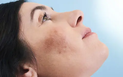 Primo piano del viso di una donna con macchie cutanee visibili, che mostra come coprire le macchie sul viso per un incarnato uniforme.