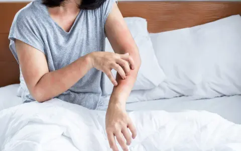 Frau kratzt sich am Arm, rote Hautstellen. Juckende Haut kann ein Symptom der Wechseljahre sein.