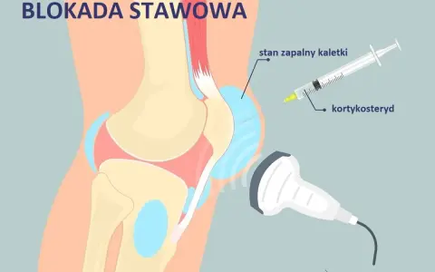 Ilustracja przedstawia blokadę stawową kolana. Zastrzyki w kolano z kortykosteroidem pod kontrolą USG pomagają przy stanie zapalnym kaletki.