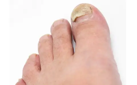 Gros plan sur un ongle d'orteil atteint d'un décollement ongle choc, jauni et épaissi.