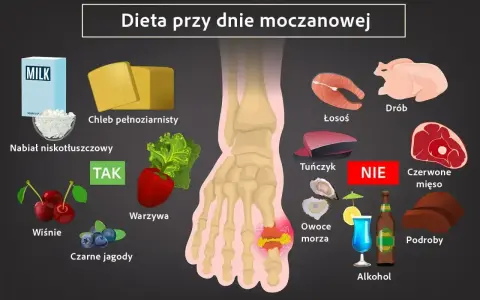 Dieta przy dnie moczanowej: TAK - nabiał, chleb, warzywa, wiśnie, jagody. NIE - drób, łosoś, tuńczyk, czerwone mięso, podroby, owoce morza, alkohol. Pomaga obniżyć podniesiony kwas moczowy.