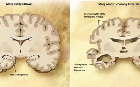 Porównanie mózgu zdrowego i z chorobą Alzheimera. Widać ubytek kory mózgowej i hipokampa, co pokazuje, jak alzheimer ile się żyje, zmienia mózg.