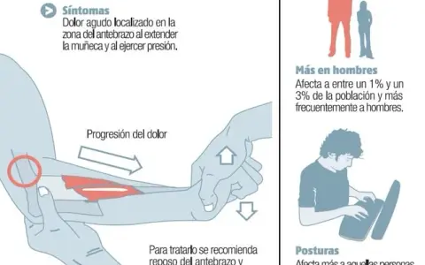 Codo de tenista: Síntomas clave, causas y alivio efectivo ¿Lo sufres?