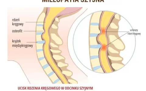 Objawy neurologiczne kręgosłupa szyjnego: kiedy to poważne?