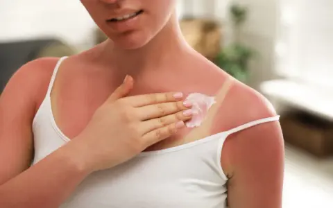 Une femme applique une crème apaisante sur son coup de soleil. Le Cicalfate aide à soulager la peau irritée.