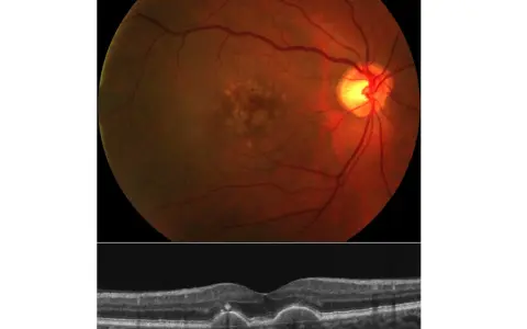 Immagine OCT e fondo oculare che mostrano segni di degenerazione maculare, il cui significato è cruciale per la diagnosi.