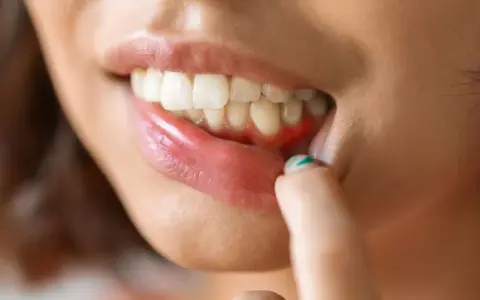 Czy antybiotyk pomoże na ból zęba? Prawda o leczeniu bólu zęba