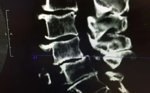 Radiographie montrant l'arthrose cervicale d'un cheval, avec des signes de dégénérescence osseuse au niveau des vertèbres.