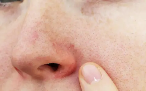 Gros plan sur un nez avec une légère rougeur autour des narines et des pores visibles. Un doigt effleure la peau.