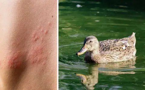 Haut mit roten Pusteln, die auf einen Zerkarien Ausschlag hindeuten, neben einer Ente im Wasser.