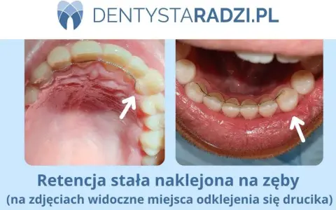 Ile kosztuje nakładka retencyjna? Ceny, opcje i porady eksperta