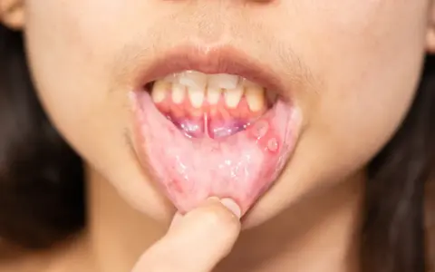 Afta na wardze, która może być objawem leukoplakii. Widoczne białe owrzodzenia i zaczerwienienie.