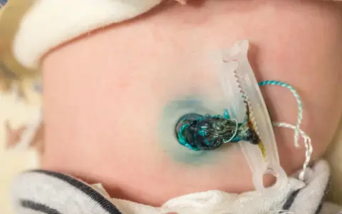 Piccolo granuloma ombelicale con clip e cordone residuo su pelle neonatale.