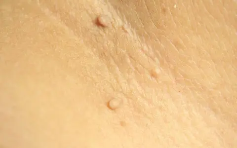 Gros plan sur une peau claire montrant plusieurs petites excroissances cutanées, certaines ressemblant à des grains de beauté ou des verrues.
