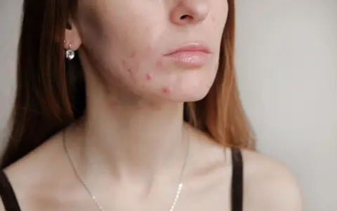 Primer plano de una joven con granos en la cara, mostrando la textura de su piel y algunas imperfecciones.