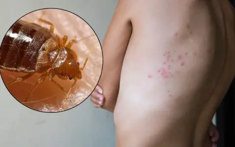 Primer plano de una chinche sobre piel humana, con erupciones rojas visibles en la espalda, indicando picaduras de chinches en el cuerpo.