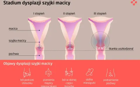 Grafika przedstawia stadia dysplazji szyjki macicy: I, II i III stopień, z zaznaczoną tkanką uszkodzoną w III stadium. Poniżej objawy: ból podczas stosunku, plamienia, ból brzucha, obfite miesiączki, podrażnienie pochwy.