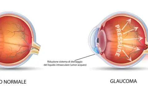 Confronto tra occhio normale e occhio con glaucoma. L'immagine mostra come la pressione elevata nel glaucoma danneggi il nervo ottico.