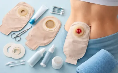 Zestaw do pielęgnacji stomii: worek, przylepce, nożyczki, kremy i spraye. Urostomia co to? To stomia moczowa.