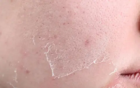 Close-up of dry, flaky skin with peeling patches, indicating what causes transepidermal water loss.
