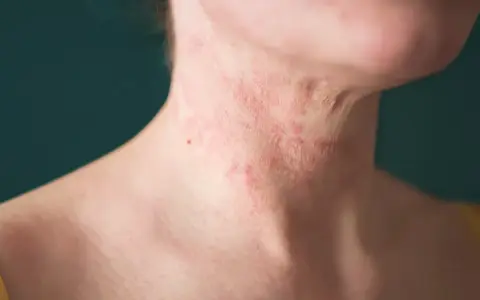 Close-up of a person's neck with red, inflamed eczema. Some find relief from itching, wondering why does hot water feel good on eczema.