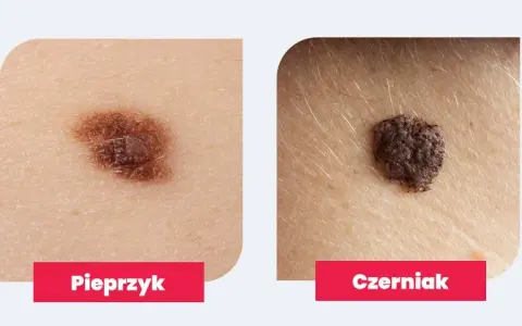 Dlaczego pieprzyk boli jak pryszcz? Objawy, które mogą niepokoić