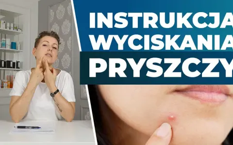 Jak wycisnąć pryszcza? Poradnik eksperta: Bezpiecznie i bez blizn