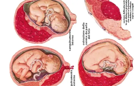 Illustrazioni mediche mostrano complicazioni della gravidanza: sanguinamento interno/esterno, ostruzione cervicale e distacco prematuro della placenta, evidenziando la placenta bassa.