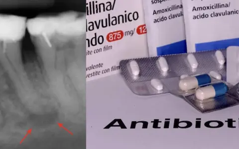 Radiografia dentale con segni di infezione e confezioni di amoxicillina/acido clavulanico, un antibiotico e antinfiammatorio.