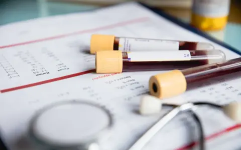 Wyniki badań wskazują, że mcv za wysokie. Obok leżą probówki z krwią i stetoskop.