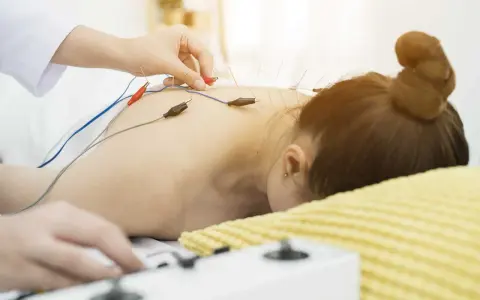 Elektroakupunktura: igły z elektrodami na plecach pacjentki. Choć metoda ta ma wiele zalet, warto pamiętać o potencjalnych skutkach ubocznych.