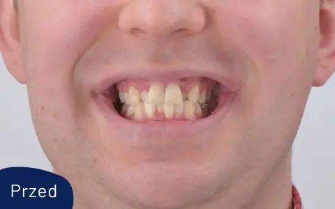 Uśmiech przed leczeniem aparatem Invisalign. Widoczne nierówne i lekko pożółkłe zęby.