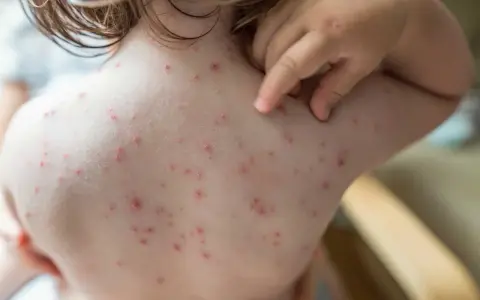 Un enfant se gratte le dos couvert de boutons de varicelle. Le traitement de la varicelle vise à soulager les démangeaisons.