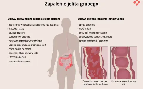 Ilustracja przedstawia objawy zapalenia jelita grubego, takie jak biegunka, ból brzucha, krew w kale, gorączka i zmęczenie.