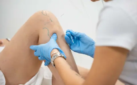 Terapeuta w niebieskich rękawiczkach wykonuje igłoterapię suchą na kolanie pacjenta, wprowadzając cienkie igły.