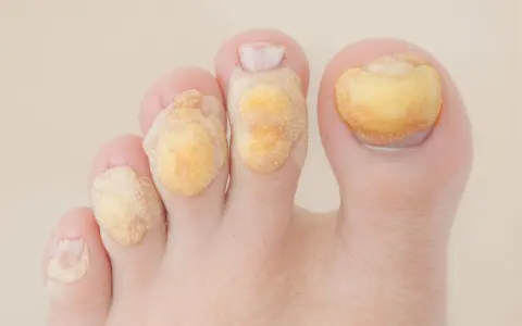 Pieds avec plusieurs pansements pour l'extraction de cors.