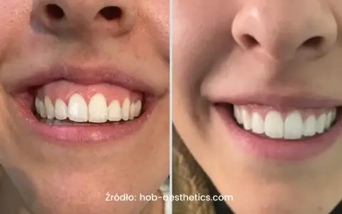 Uśmiech z widocznymi zębami i dziąsłami, porównanie przed i po zabiegu. Zniknął problem gummy smile.