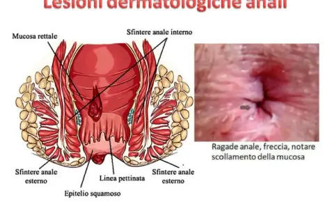 Illustrazione anatomica dell'ano e immagine ravvicinata di una ragade anale con freccia che indica lo scollamento della mucosa. Si notano puntini bianchi nell'area anale.