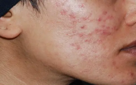 Primo piano del viso di una persona con evidenti cicatrici da acne sul lato destro della guancia e sul mento.
