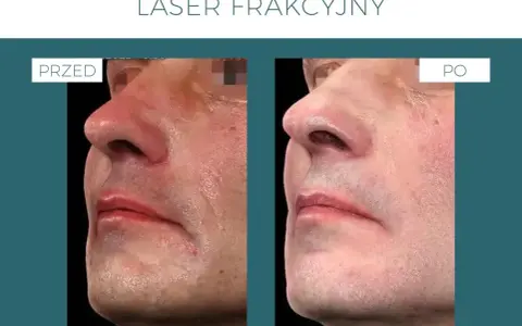 Laser frakcyjny: Skutki uboczne? Co jest normą, a co alarmem?