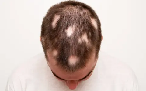 Calvizie a chiazze sulla testa di un uomo, sintomo di alopecia da stress.