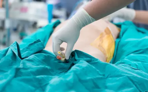 Ręka w rękawiczce zakłada cewnik u kobiety. Medyczna procedura w trakcie zabiegu.