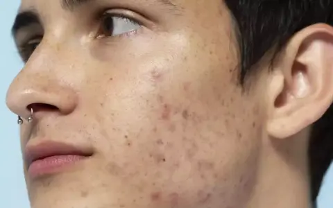 Primo piano del volto di un giovane con piercing al naso, che mostra le imperfezioni della pelle come brufoli e macchie.