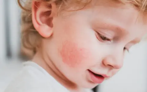 Un enfant avec une rougeur sur la joue, possiblement du pityriasis alba.