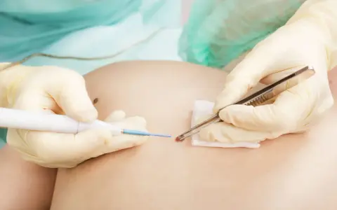 Arzt entfernt mit Pinzette und Laser ein Muttermal rot umrandet.