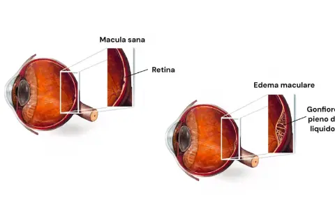 Confronto tra occhio sano e occhio con edema maculare. L'edema maculare si riassorbe, mostrando la retina gonfia e piena di liquido.