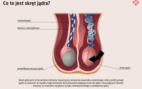 Ilustracja pokazuje skręt jądra, stanowiący przyczynę silnego bólu jądra, gdzie powrózek nasienny ulega skręceniu, blokując dopływ krwi.
