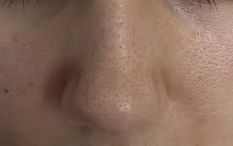 Primo piano del naso con evidenti punti neri, la pelle appare lucida e porosa.