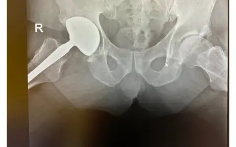 Endoproteza stawu biodrowego nfz gdzie najlepiej – wybierz mądrze