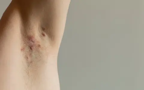 Skóra pod pachą z widocznymi zmianami zapalnymi, które mogą wskazywać na trądzik odwrócony.
